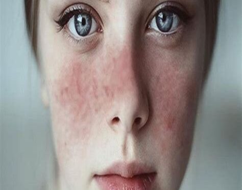 Kelebek Hastalığı İle Mücadelede Öneriler