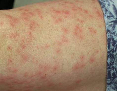 Uyuz Hastalığı Tanısı Nasıl Konulur?