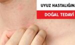 Uyuz Bulaşmasını Engellemek İçin Ne Yapmalıyız?