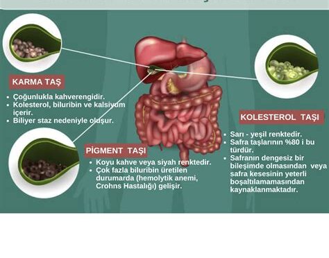 Sindirim Problemleri ve Çözüm Önerileri: Sindirim Sistemi Sağlığını Desteklemek