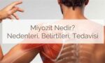 Miyozit: Nedir? Tipleri, Nedenleri, Belirtileri ve Tedavisi