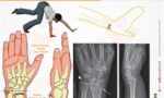 Colles Kırığı: Nedir? Nedenleri, Belirtileri, Tedavisi, Rehabilitasyonu