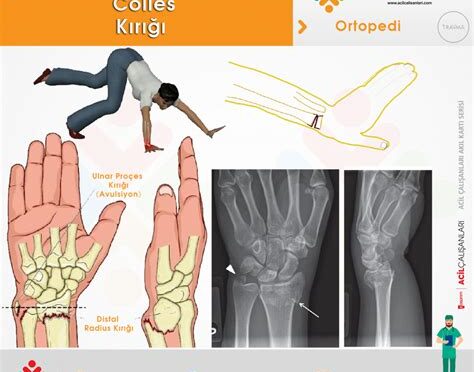 Colles Kırığı: Nedir? Nedenleri, Belirtileri, Tedavisi, Rehabilitasyonu