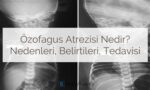 Özofagus Atrezisi: Nedir? Nedenleri, Belirtileri ve Tedavisi