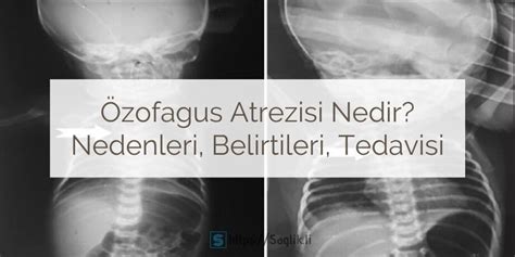 Özofagus Atrezisi: Nedir? Nedenleri, Belirtileri ve Tedavisi