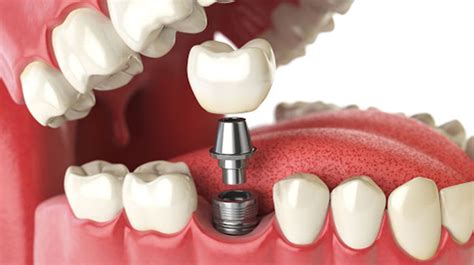İmplant Nedir? Diş Implantı Tedavisi Hakkında Bilmeniz Gerekenler