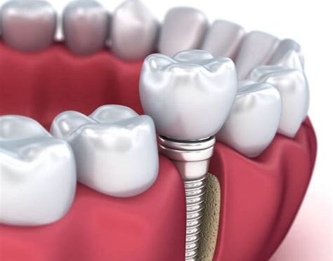 Diş Implantı Kimlere Uygulanır? Tedaviye Uygun Durumlar
