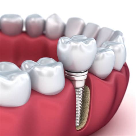 Diş Implantı Kimlere Uygulanır? Tedaviye Uygun Durumlar