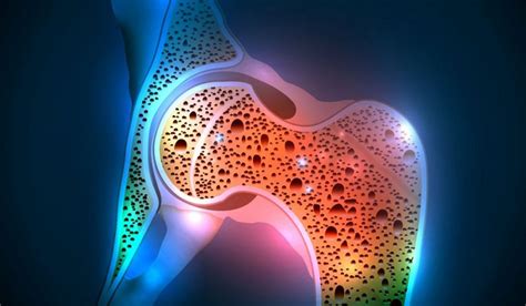 Kemik Erimesi (Osteoporoz) Nedir? Nedenleri ve Korunma Yöntemleri
