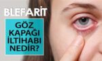 Göz Kapağı İltihabı (Blefarit) Neden Olur? Tedavi Edilir Mi?