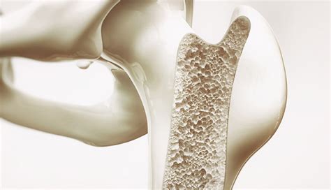 Kemik Erimesi (Osteoporoz) Nedir? Korunma Yöntemleri