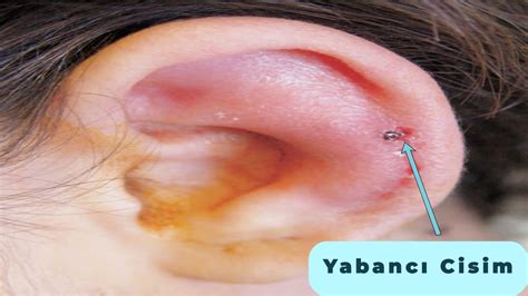 Perikondrit - Kulak Kepçesi İltihabı - Tedavisi