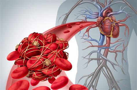Trombotik Trombositopenik Purpura Nedir?