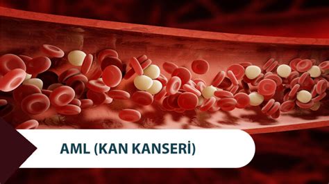 Akut Myeloblastik Lösemi Belirtileri Nelerdir?