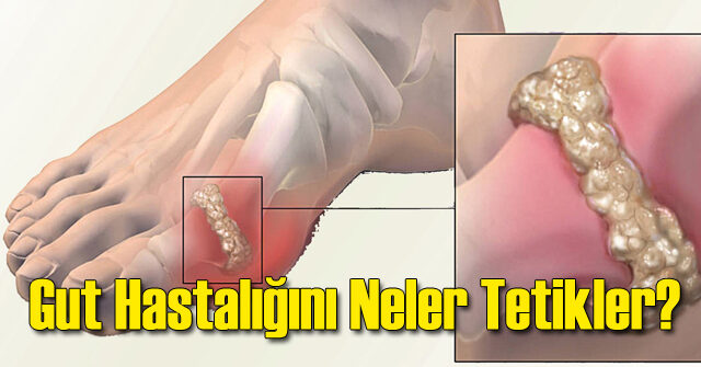 Gut Hastalığının Artış Nedenleri ve Önlenmesi