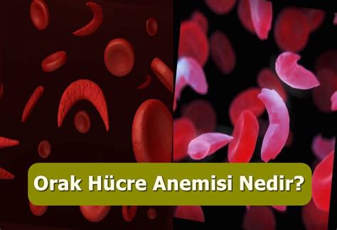 Orak Hücreli Anemi Nedir? Belirtileri, Tedavisi ve Taşıyıcı Olma Riski